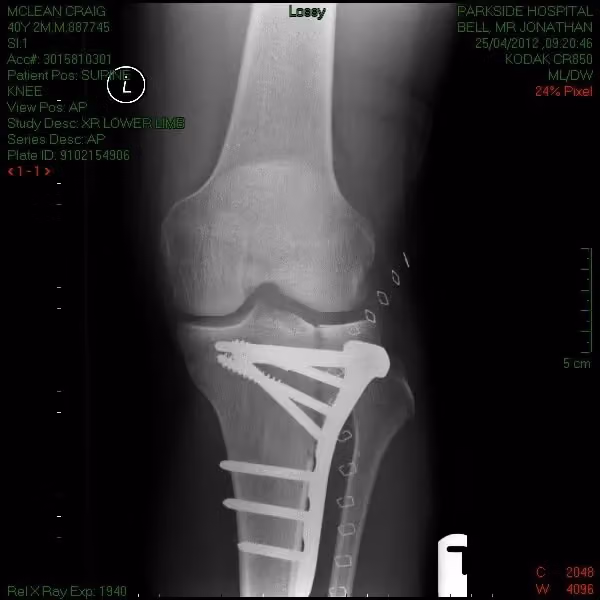 X-ray of the knee and fixation plate from the side