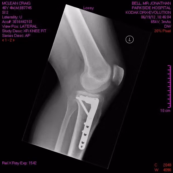 Side-view X-ray of the knee showing the plate during healing