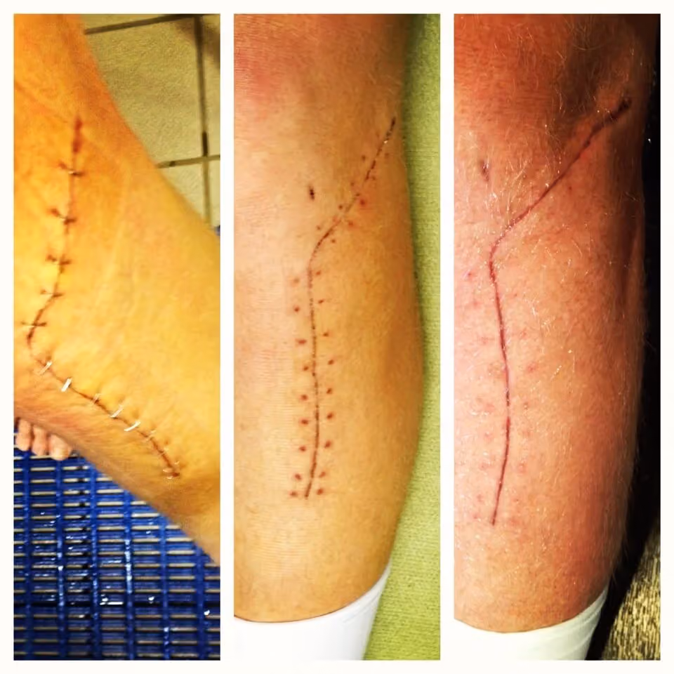 Three stages of the surgical scar healing along the knee and shin