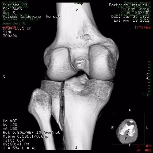 3D CT reconstruction of the knee from behind