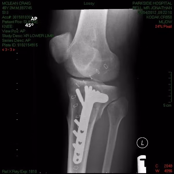 Follow-up X-ray of the plate and screws taken at 45 degrees
