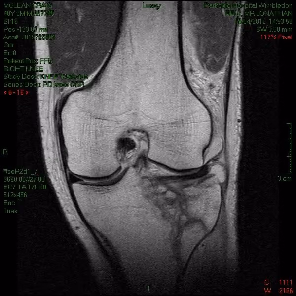 Second MRI view of the knee joint showing the fracture damage