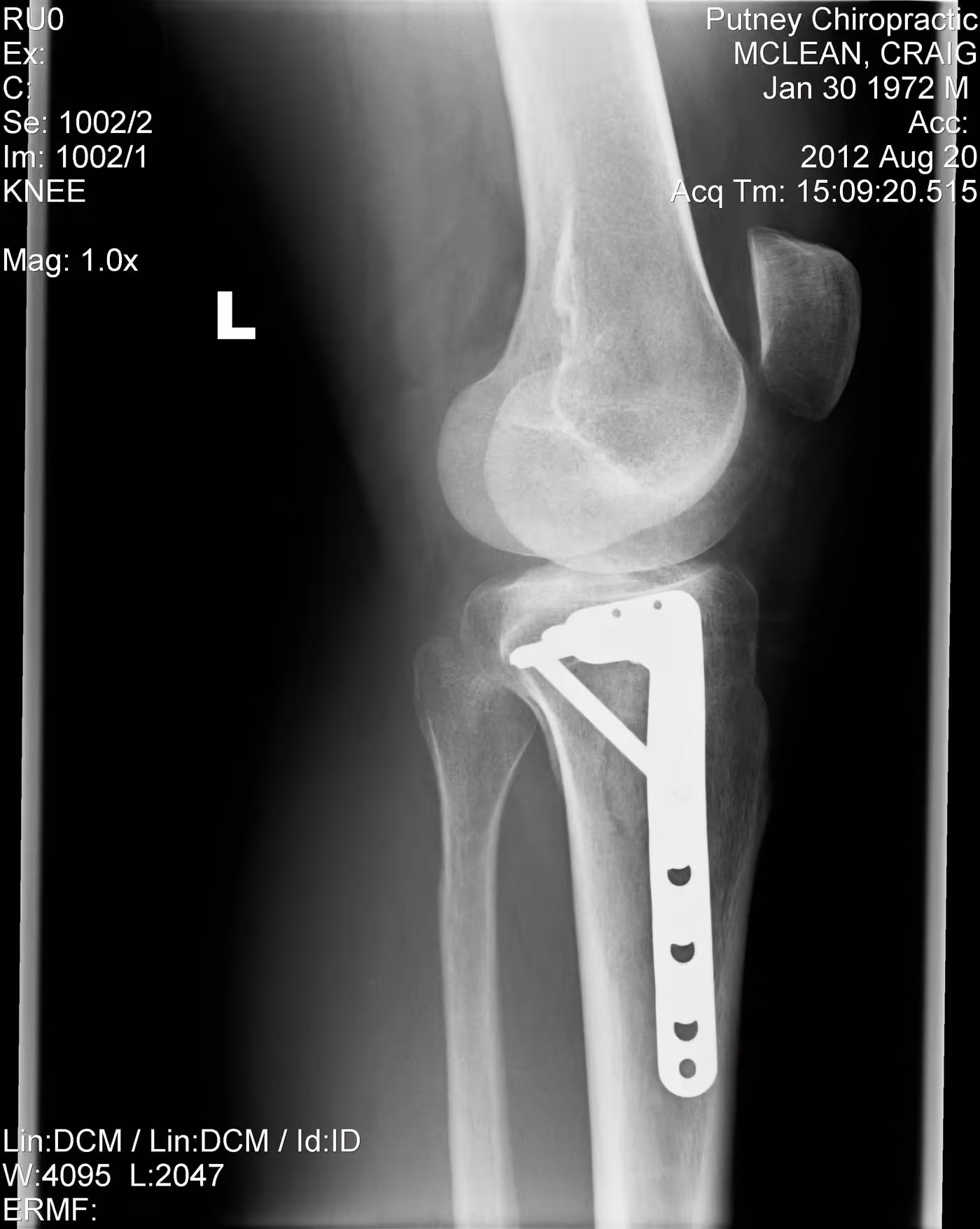 X-ray showing the full plate and screw fixation along the tibia