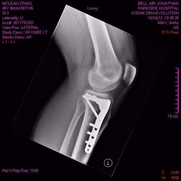 Lateral X-ray of the knee with the fixation plate