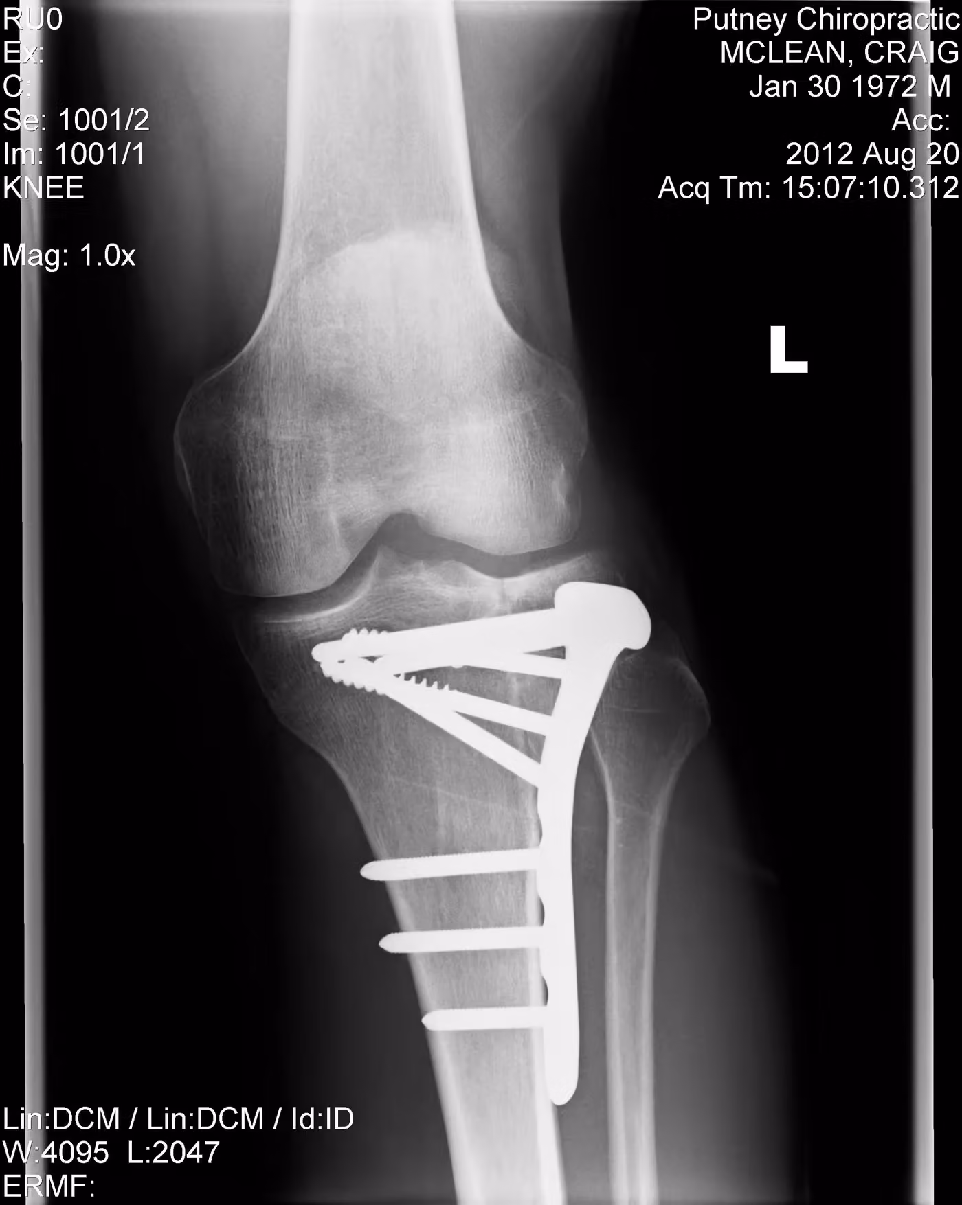 X-ray of the repaired tibial plateau, angled view