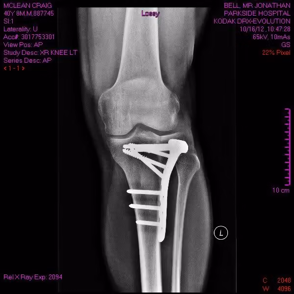 Front-view X-ray of the healing tibial plateau with the hardware in place