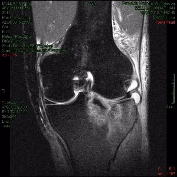 MRI scan of the injured knee showing the tibial plateau fracture