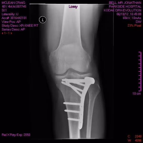 X-ray of the lower leg with the metal plate and screws fitted, front view