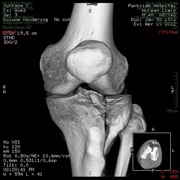 3D CT reconstruction of the knee joint showing the fracture