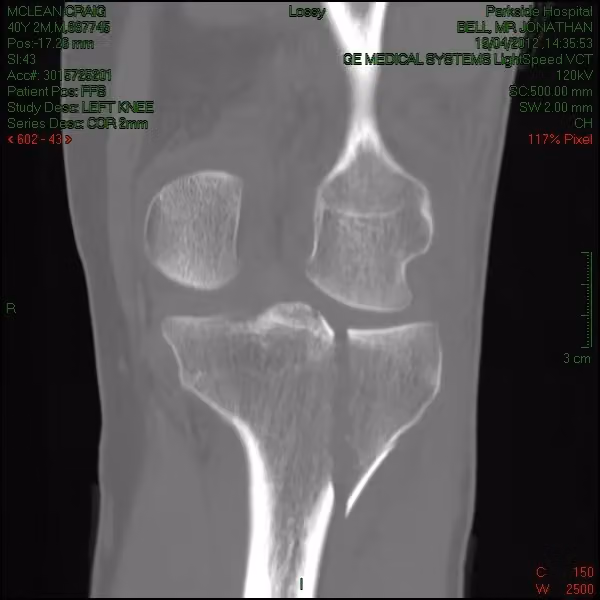 CT scan slice through the knee joint